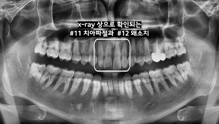 라미네이트