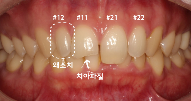 라미네이트
