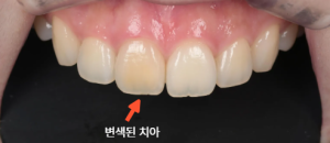 신경치료, 실활치미백