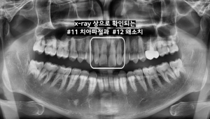 라미네이트
