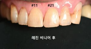 이갈이,레진