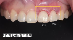 라미네이트
