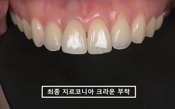 새로 제작한 #11번 지르코니아 크라운을 임시접착해 주변 치아와 교합을 확인한 모습