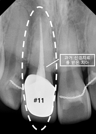 기존 크라운 아래 #11번 오른쪽 위 첫 번째 앞니의 어두워진 자연치와 주변 상태를 확인한 모습