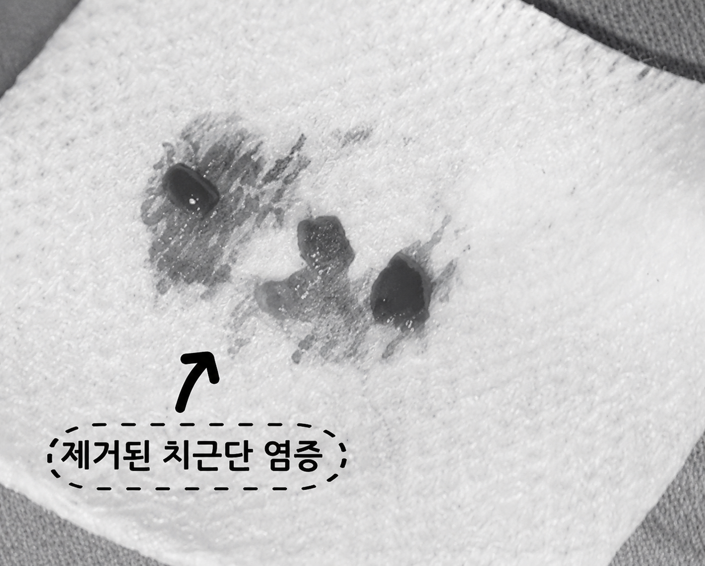 염증 조직을 제거한 뒤 #37번 어금니의 뿌리 끝을 MTA로 밀폐한 모습