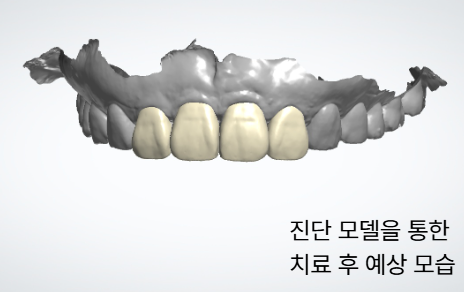 진단 모델을 통해 위쪽 앞니의 치료 후 예상 길이와 형태를 확인한 모습
