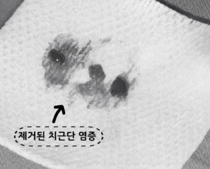 염증 조직을 제거한 뒤 #37번 어금니의 뿌리 끝을 MTA로 밀폐한 모습