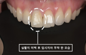 #11번 오른쪽 위 첫 번째 앞니에 BOPT를 시행해 새로운 크라운을 위한 치아와 잇몸 경계를 정리한 모습