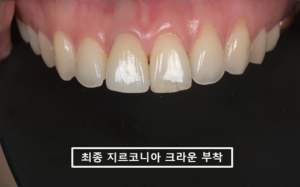 새로 제작한 #11번 지르코니아 크라운을 임시접착해 주변 치아와 교합을 확인한 모습