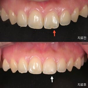 파절된 #21번 왼쪽 위 첫 번째 앞니의 레진 수복 전후 길이와 형태 변화