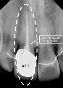 기존 크라운 아래 #11번 오른쪽 위 첫 번째 앞니의 어두워진 자연치와 주변 상태를 확인한 모습