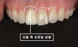 잇몸 쪽으로 보랏빛이 비쳐 보이는 #11번 오른쪽 위 첫 번째 앞니의 기존 크라운 모습