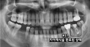 치아재식술 후 회복 상태를 확인하고 지르코니아 크라운으로 보철 치료를 진행한 #37번 어금니