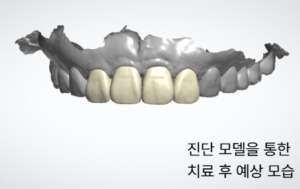 진단 모델을 통해 위쪽 앞니의 치료 후 예상 길이와 형태를 확인한 모습