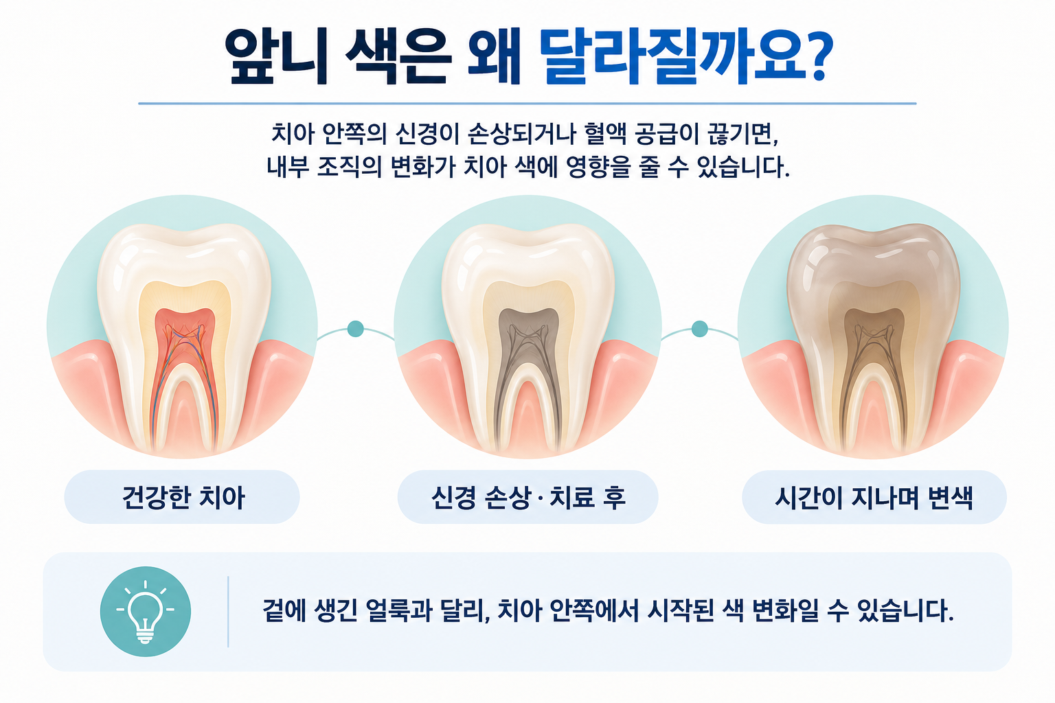 신경치료 후 시간이 지나면서 앞니가 어두워질 수 있는 변색 과정을 설명한 이미지