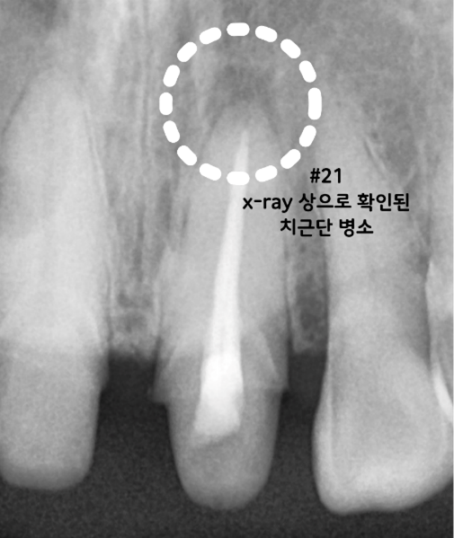 신경치료한 #21번 왼쪽 위 가운데 앞니의 뿌리 끝 주변 병소가 확인된 방사선사진