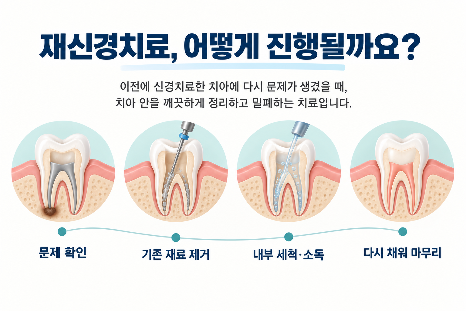 기존 근관재료 제거부터 내부 세척과 근관충전까지 재신경치료 과정을 설명한 이미지