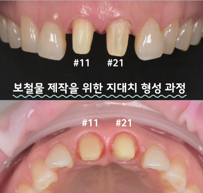 기존 보철물을 제거한 #11번과 #21번 앞니를 크라운 제작을 위해 다듬은 지대치 모습