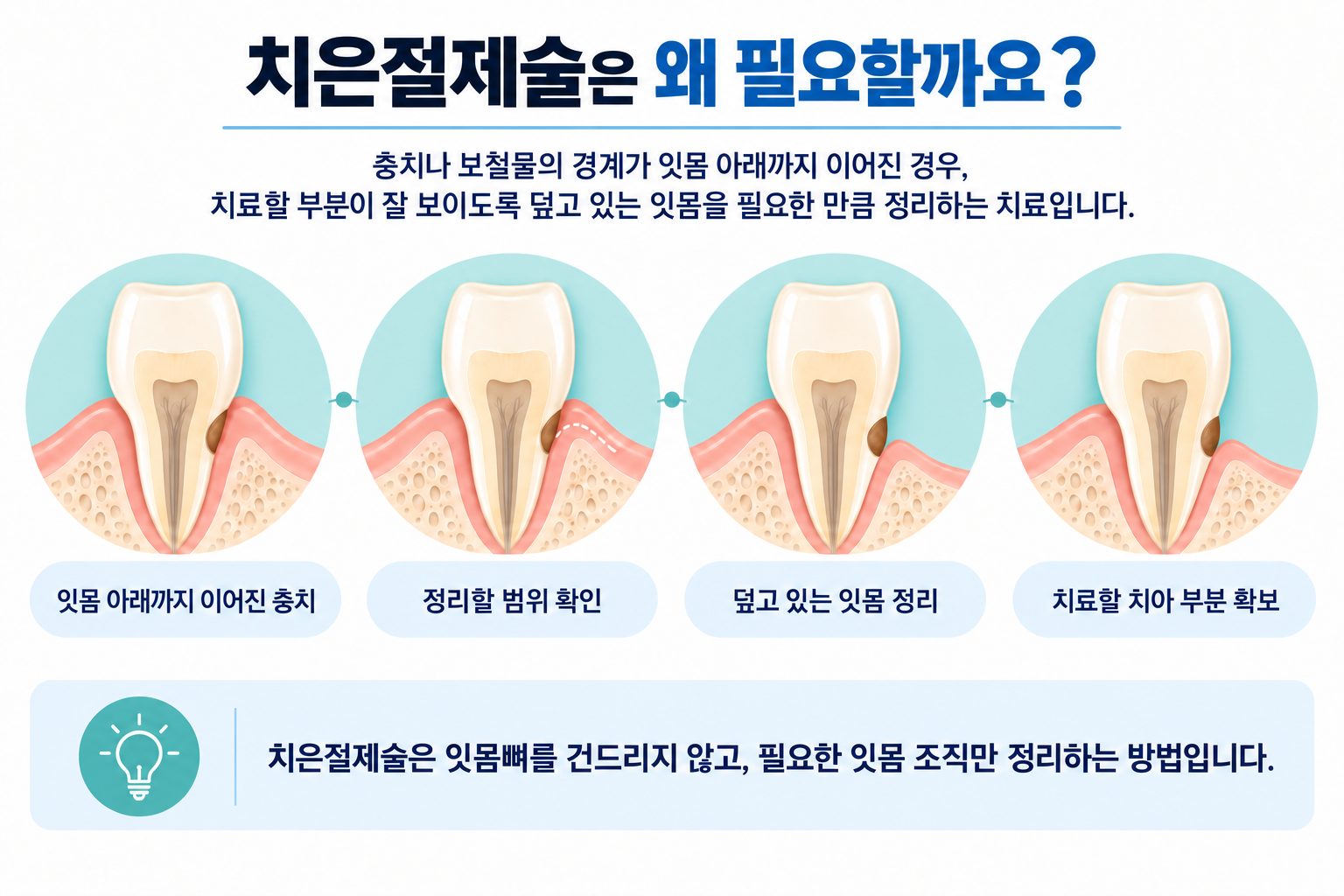 잇몸에 가려진 치아 부위를 드러내 보철치료에 필요한 공간을 만드는 치관연장술 과정