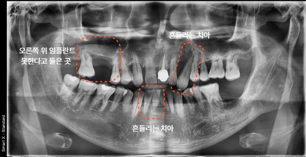 처음 내원 당시 전체 방사선 사진 2025.06.28