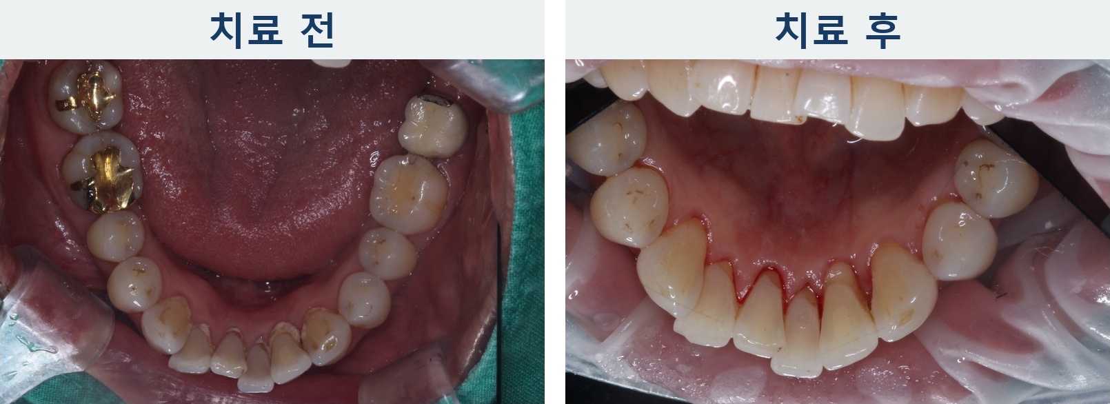 착색 제거 전후 아래 앞니와 하악 교합면의 치아 표면을 비교한 사진, lower teeth stain removal before and after