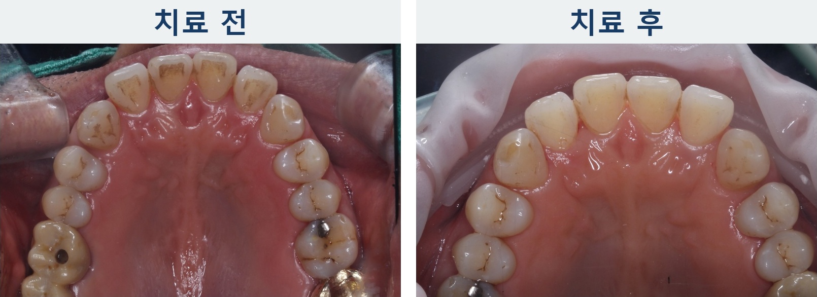 에어플로우 착색 제거 전후 위 앞니 안쪽과 상악 교합면을 비교한 사진, upper teeth air polishing before and after