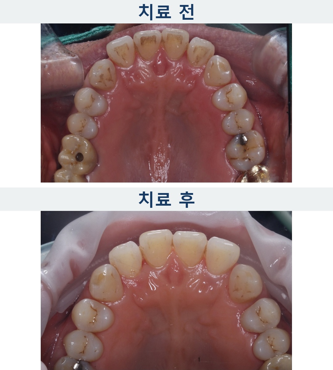치아 안쪽에 갈색 얼룩이 많이 보인다면? 착색 제거 사례