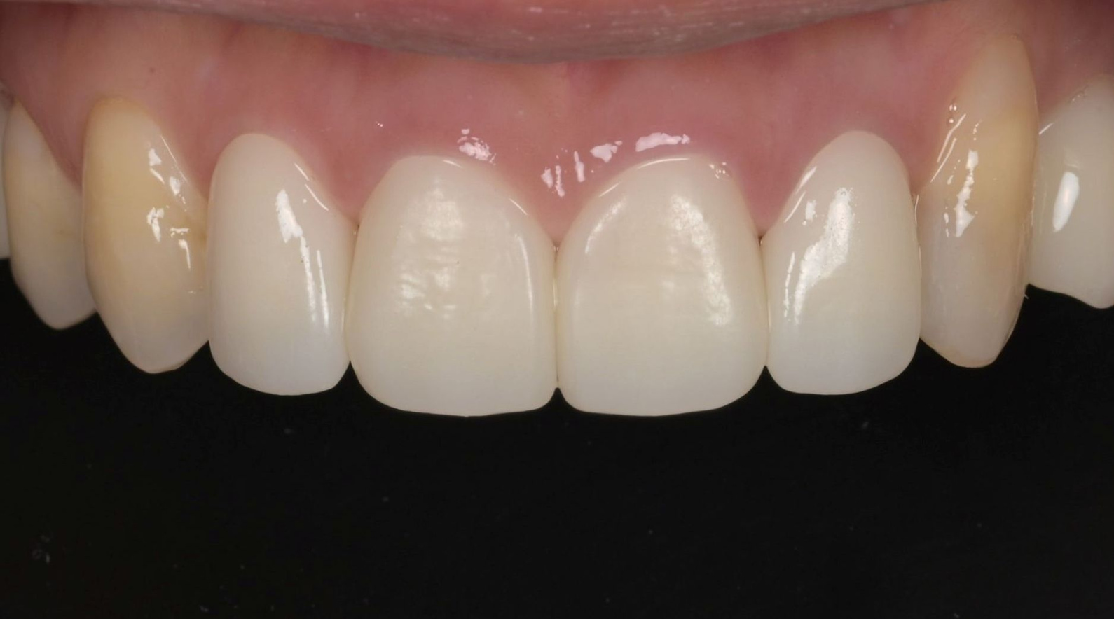 재신경치료와 미백 후 새 지르코니아 앞니 보철을 장착한 모습