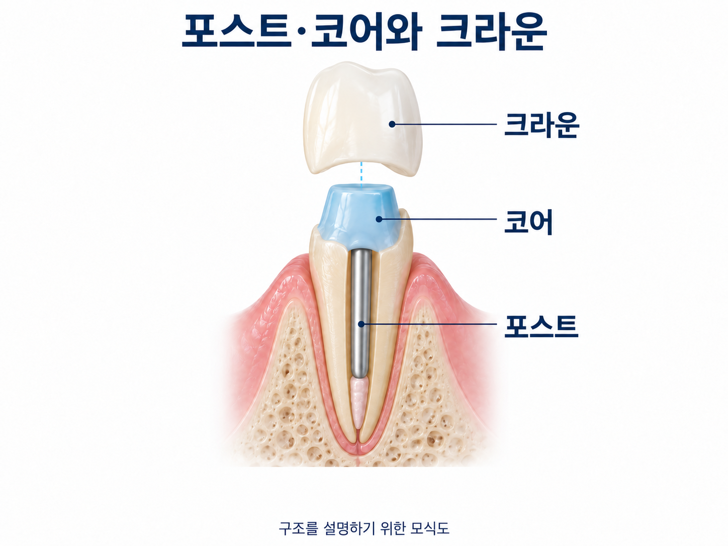 은색 포스트와 파란색 코어, 크라운의 구조를 보여주는 설명용 모식도