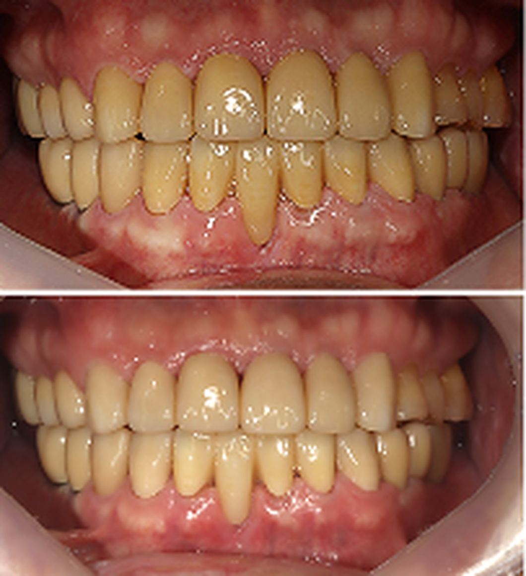연세위시치과 환자 의견을 반영한 앞니 크라운 색상 조정 전후 정면 비교, anterior crown shade adjustment comparison