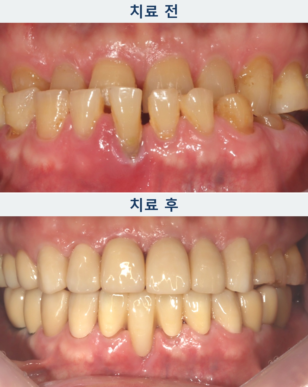 연세위시치과 어금니 임플란트와 앞니 크라운 치료 전후 치아 길이와 교합의 정면 비교, implant and anterior crown rehabilitation before and after