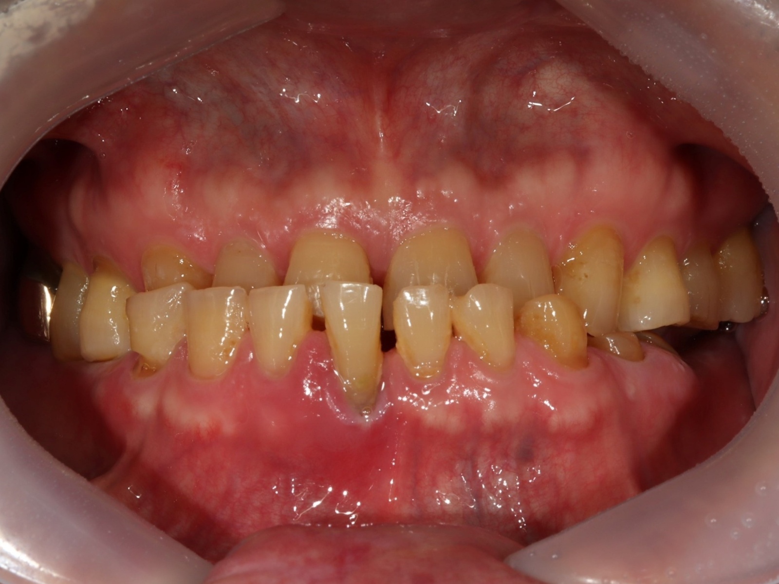연세위시치과 치료 전 짧게 닳은 앞니와 반대교합이 보이는 정면 구강사진, worn anterior teeth and crossbite before implant and crown rehabilitation