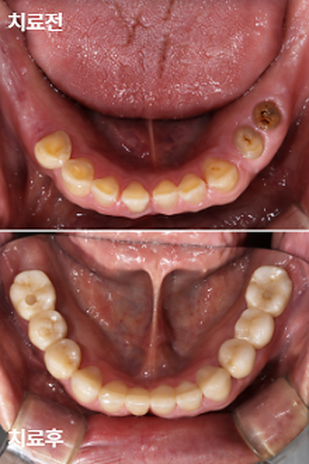 연세위시치과 아래 양쪽 어금니 임플란트 보철치료 전후 교합면 비교, lower occlusal before and after implant restoration