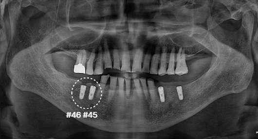연세위시치과 오른쪽 아래 45번과 46번 임플란트 식립 부위를 표시한 파노라마, lower right implant placement radiograph
