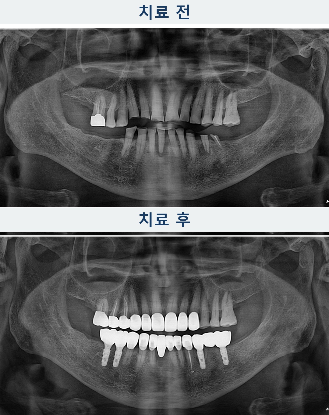연세위시치과 아래 양쪽 임플란트와 위아래 보철물을 확인할 수 있는 치료 전후 파노라마 비교, panoramic before and after implant and crown treatment
