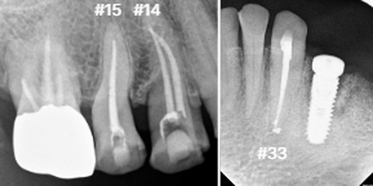 연세위시치과 오른쪽 위 14번·15번과 왼쪽 아래 33번 신경치료 후 방사선사진, root canal treatment periapical radiographs