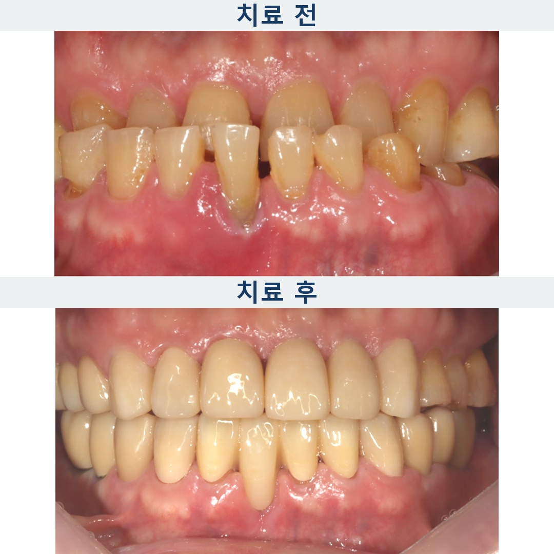 닳은 앞니, 왜 어금니부터 치료했을까요? 임플란트·크라운 사례