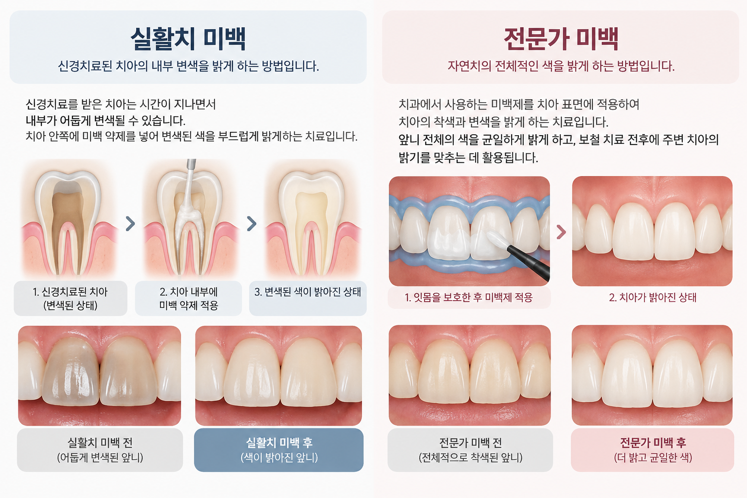 실활치 미백은 치아 내부에, 전문가 미백은 치아 표면에 미백제를 적용하는 차이를 설명한 그림