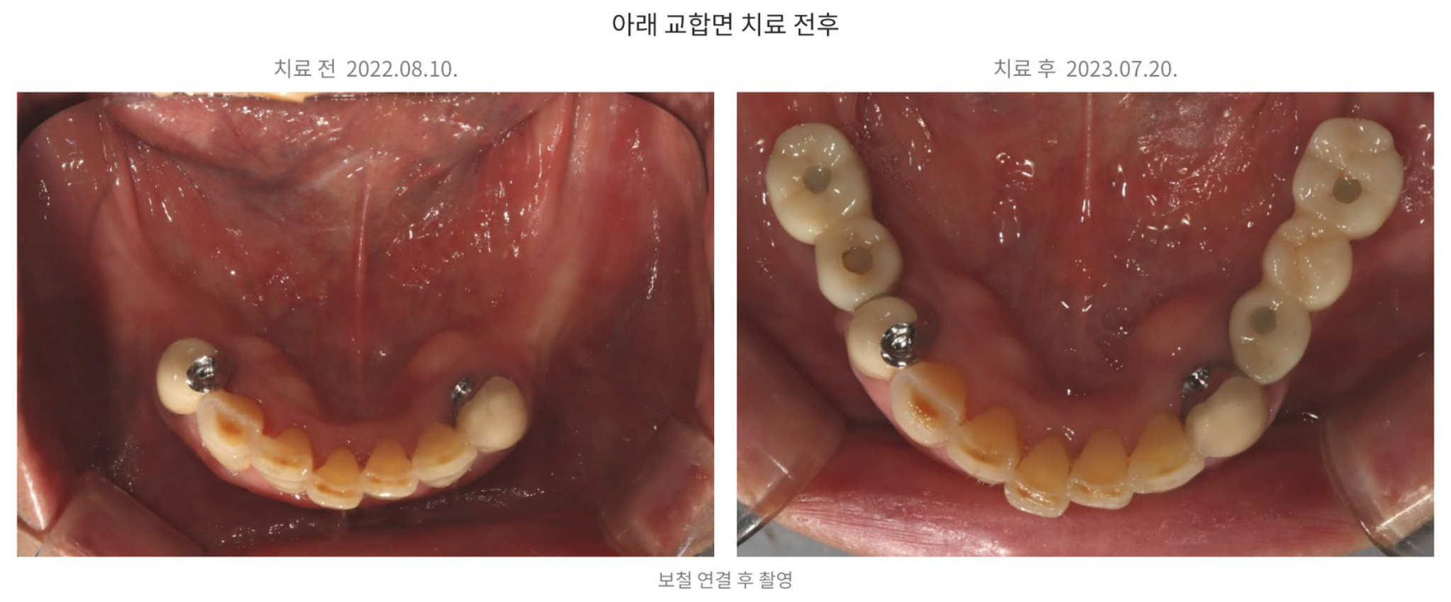 아래 양쪽 어금니 결손과 임플란트 보철 수복 후를 비교한 교합면 사진, lower molar implant occlusal before and after