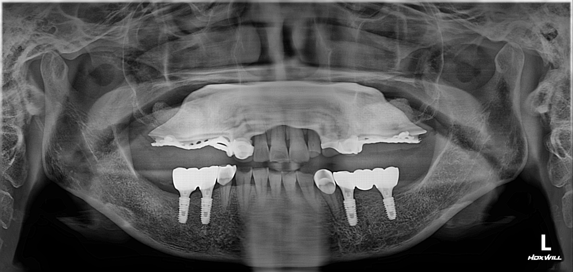 연세위시치과 아래 어금니 임플란트와 지르코니아 보철 연결 후 파노라마, lower molar implant prosthesis panoramic X-ray