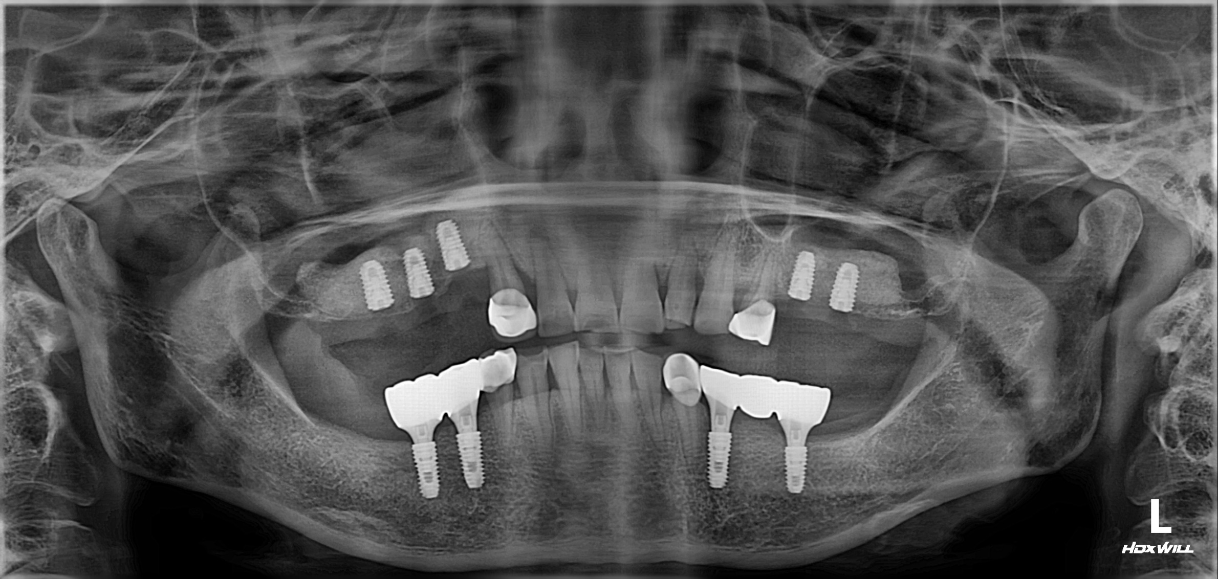 위아래 어금니 임플란트와 지르코니아 보철물의 위치가 보이는 치료 후 파노라마, final molar implant panoramic X-ray