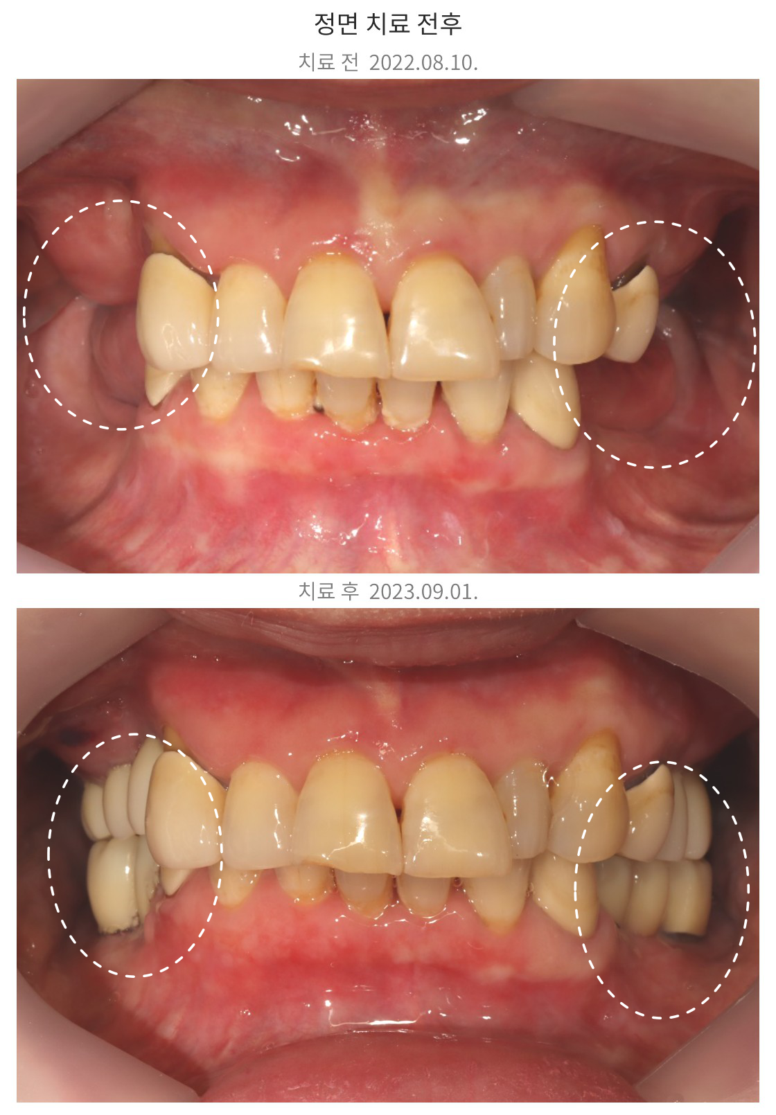 부분틀니 사용 환자의 어금니 임플란트 치료 전후 정면 구강사진, molar implant frontal before and after