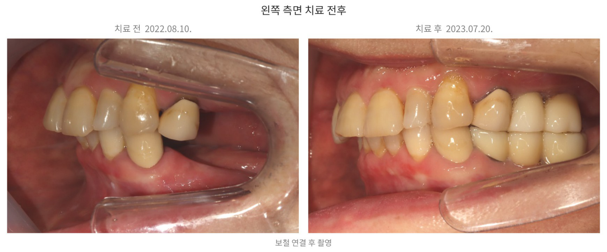 위 25·26번과 아래 34~36번 부위의 보철 수복 전후 왼쪽 측면 사진, left molar implant and bridge before and after