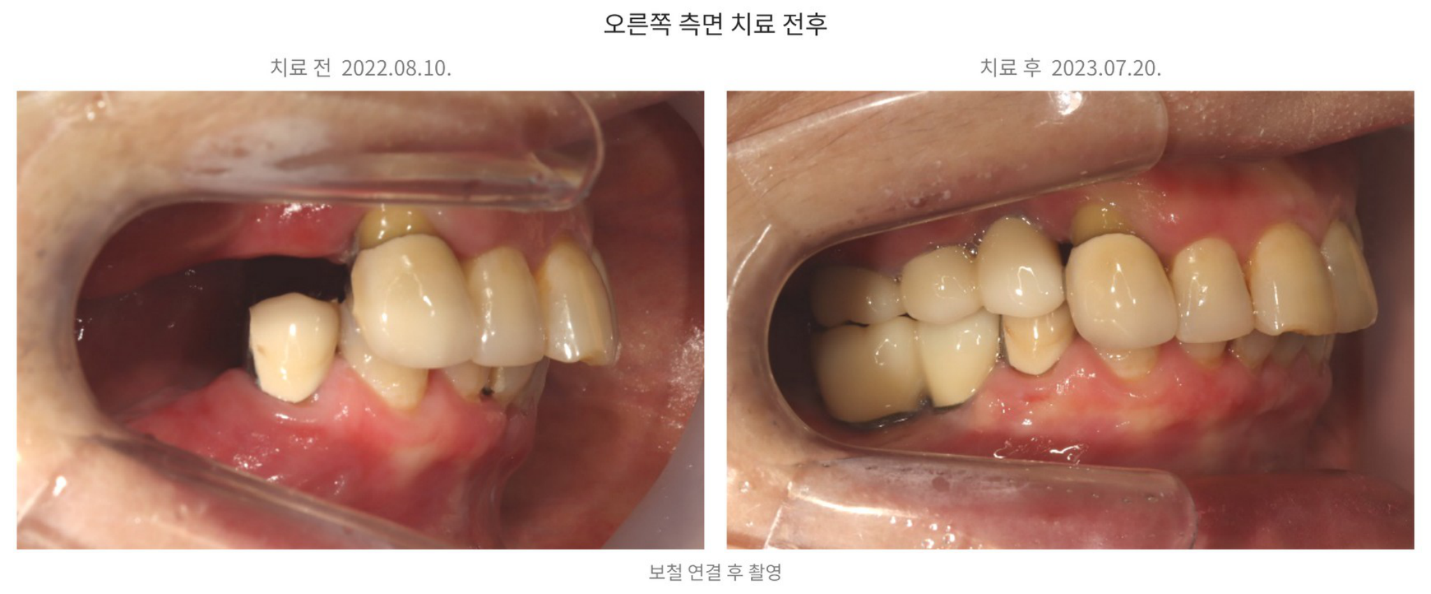 위 14·15·16번과 아래 45·46번 부위의 보철 수복 전후 오른쪽 측면 사진, right molar implant before and after