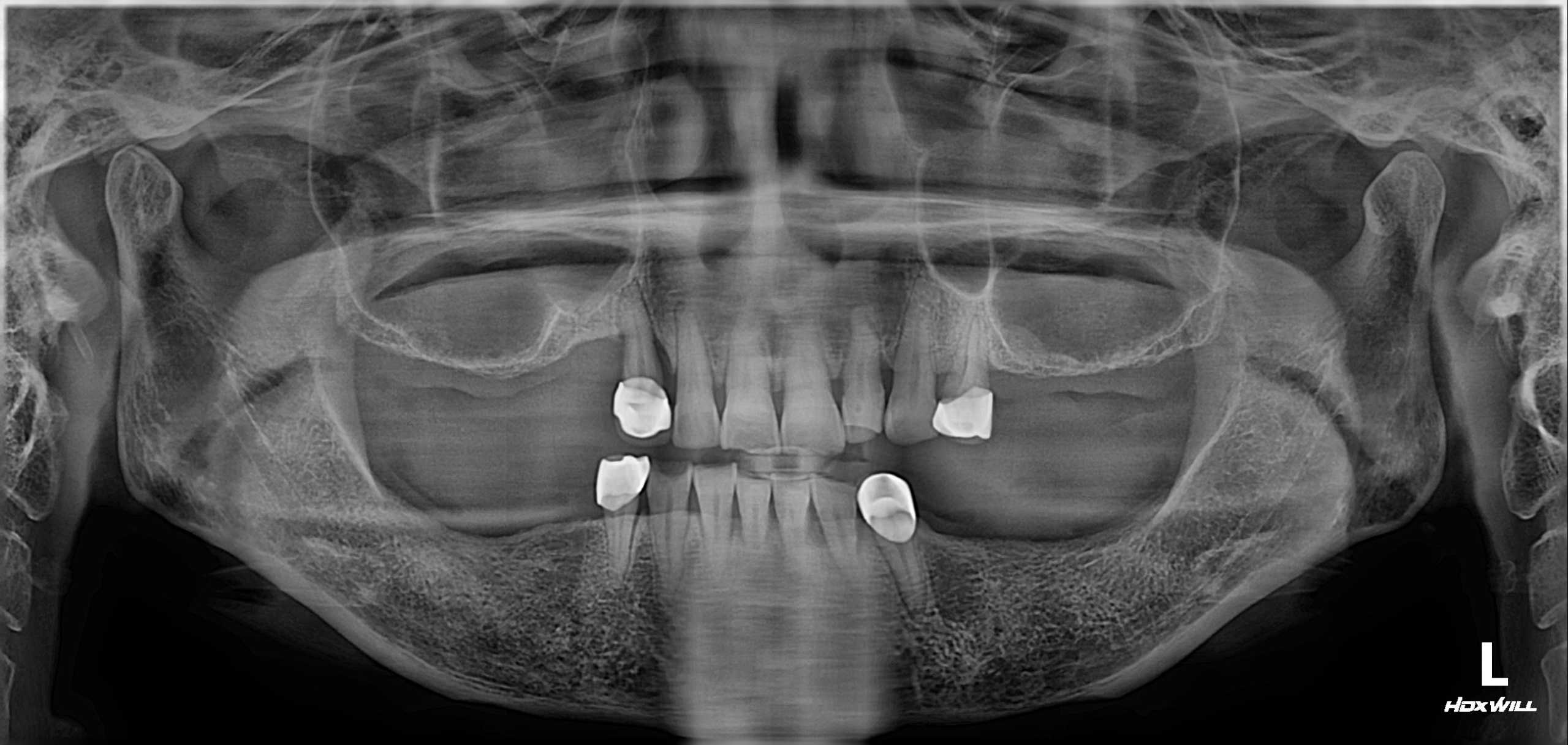 연세위시치과 부분틀니 사용 환자의 위아래 어금니 결손을 보여주는 초진 파노라마, partial denture initial panoramic X-ray