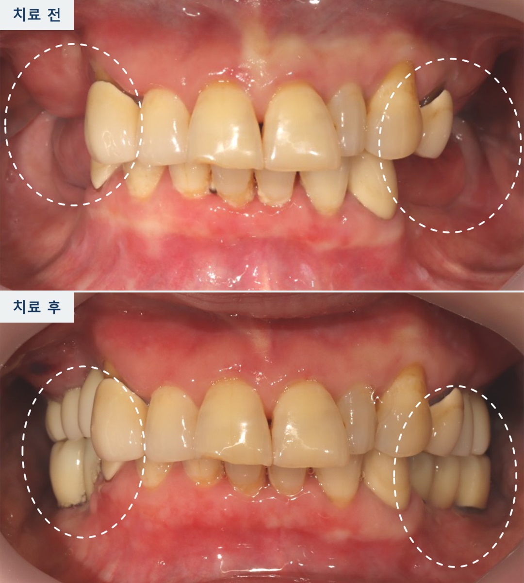 부분틀니에서 임플란트로, 위아래 어금니 치료 사례
