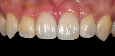 레진 빌드업으로 왼쪽 위 가운데 앞니의 길이와 윤곽을 보완한 치료 후 사진, anterior resin buildup after