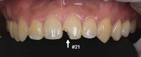 왼쪽 위 가운데 앞니 21번의 파절 부위를 표시한 치료 전 사진, fractured front tooth before resin buildup
