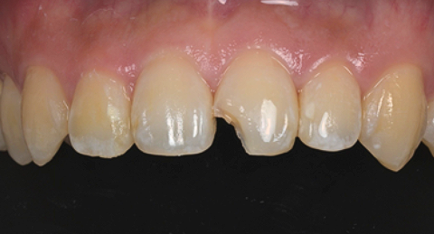 레진 수복 전 왼쪽 위 가운데 앞니의 깨진 치아 끝을 보여주는 정면 사진, anterior resin buildup before