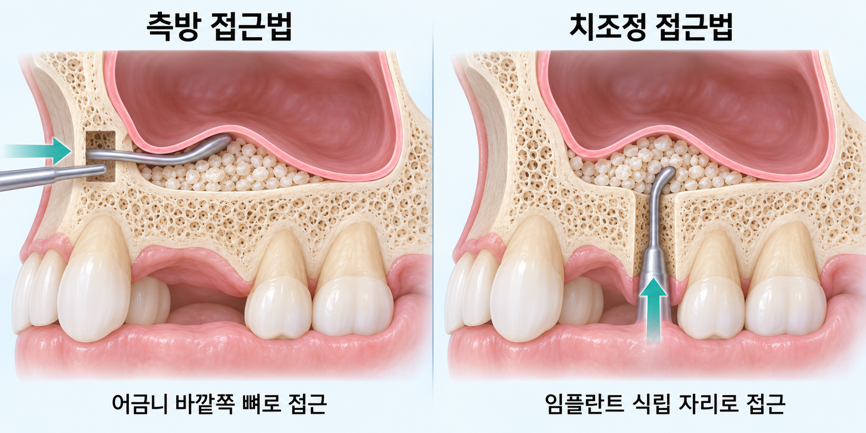 측방 접근법과 치조정 접근법을 비교하는 AI 설명 이미지, lateral and crestal sinus lift approaches; 실제 환자 사진 아님